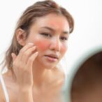 How to Treat Sunburn Fast